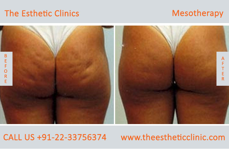 Mesotherapy for Hair Loss Face Skin Treatment before after photos in mumbai india (6)
